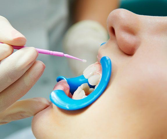 Child receiving fluoride treatment