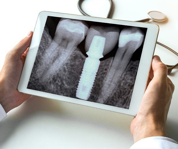 X-ray of dental implant supported replacement tooth