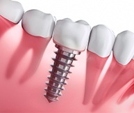 Animated implant supported dental crown