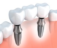 Animated implant supported fixed bridge