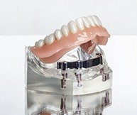 Model implant supported denture