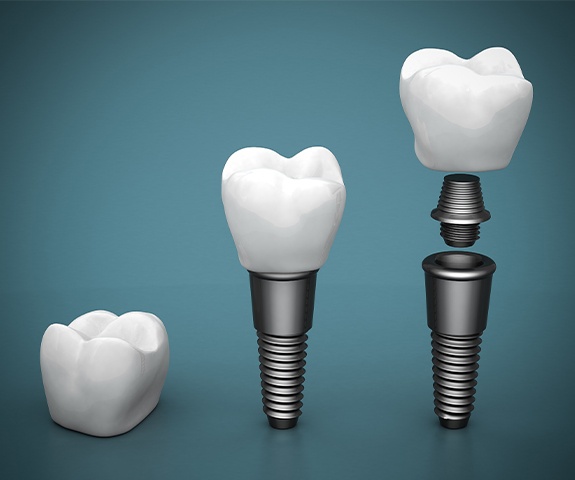 Animated parts of a dental implant replacement tooth