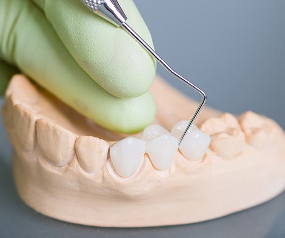 Model smile with fixed bridge restoration