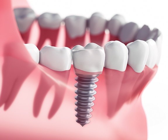 Animated implant supported dental crown