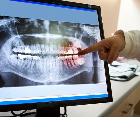 Digital dental x-rays on chairside computer